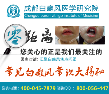 白癜风有什么表现