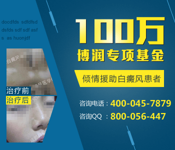 头部白癜风怎么治疗